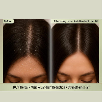 Herbal Dandruff Defense Oil™ (200ml)